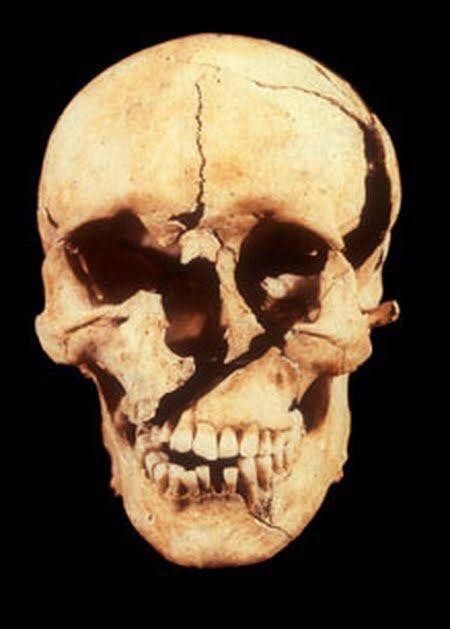 Fig. 8 : Townton 25. Crâne découvert sur le site de la bataille de Townton, Angleterre, 1461 © Université de Bradford, Angleterre
